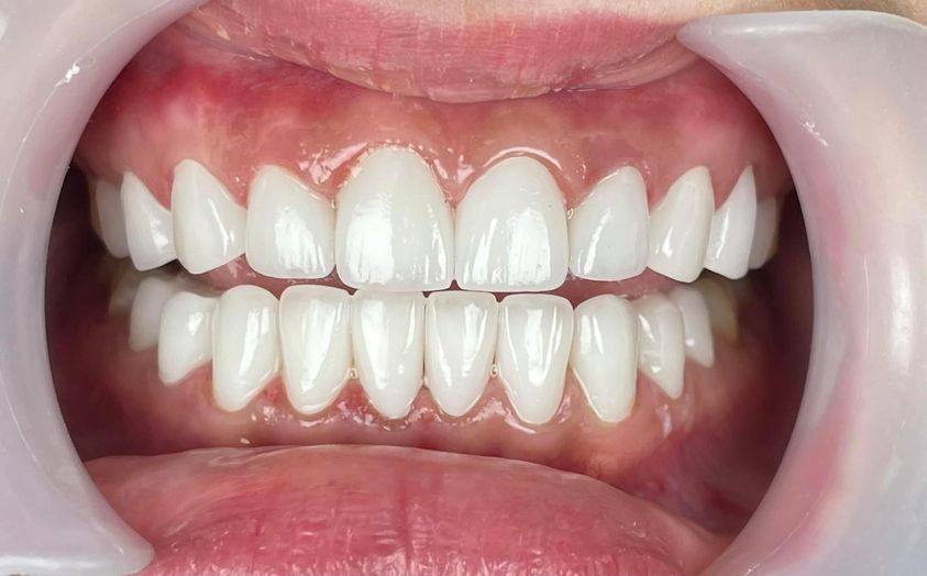 Em nhận điều trị nội nha, mài cùi cầu răng ngắn 1r 3r 5r.. thẫm mỹ 2hàm, cắt hở lợi