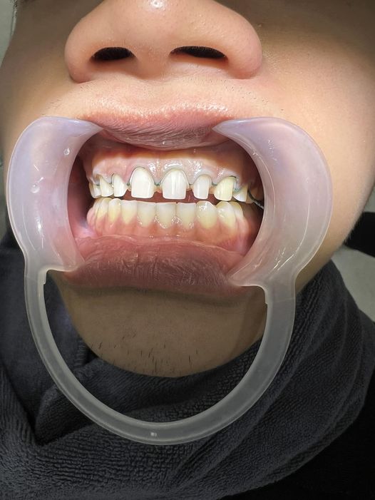 Em là nam , kinh nghiệm dc 6 năm   muốn tìm công vc điều trị tổng quát