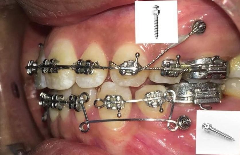 Nhakhoa hoạt động được 5 năm mong muốn  hợp tác với BS Chỉnh Nha khu vực Long An,Đồng Nai