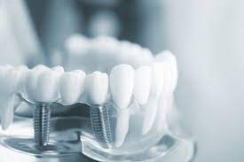 Dạ nhờ ad duyệt bài giúp ạ!  Nam bs trên 30 tuổi làm tốt Implant,chỉnh nha,phục hình