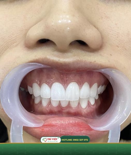 HỆ THỐNG NHA KHOA TRÍ VIỆT tuyển dụng nhân sự đi làm ngay, fulltime tại Gò Vấp.