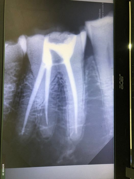 E nam(20t) - E làm dc các thủ thuật như: cạo vôi, trám răng, tẩy trắng, nội nha ổn, mài cùi cầu ngắn(❤ đơn vị)