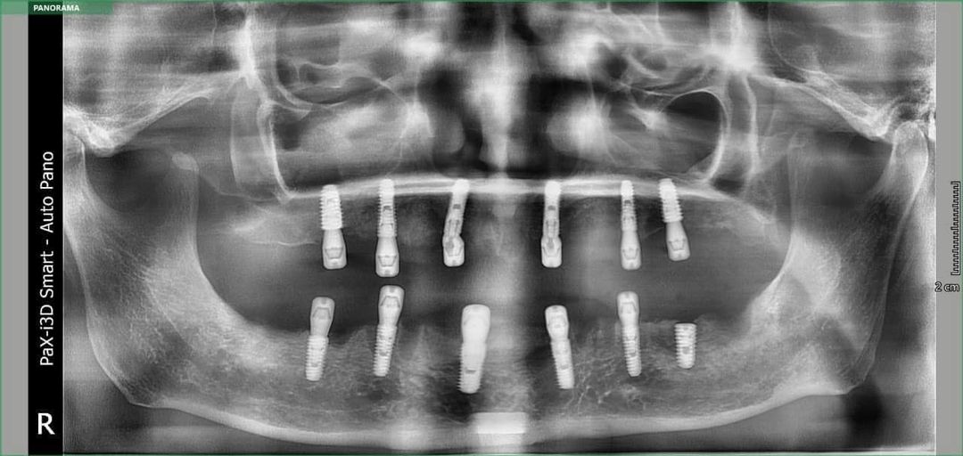 Nha khoa Vindental tuyển dụng, hợp tác 02 bác sĩ cấy ghép implant. 