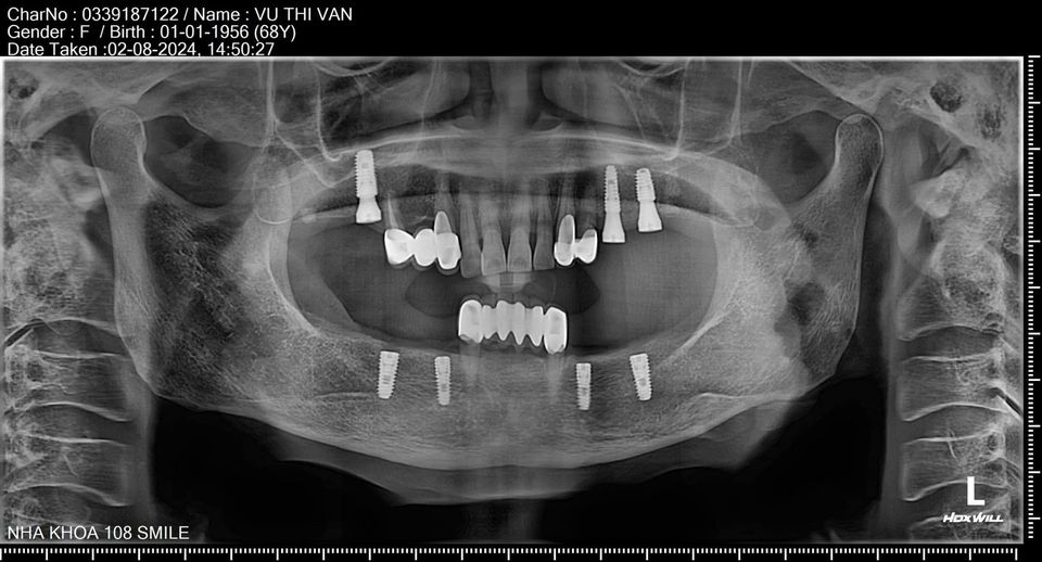 NHA KHOA QUẢNG YÊN - QUẢNG NINH  🔶️01 BÁC SĨ  có định hướng implant ,03 KTV, ĐIỀU DƯỠNG