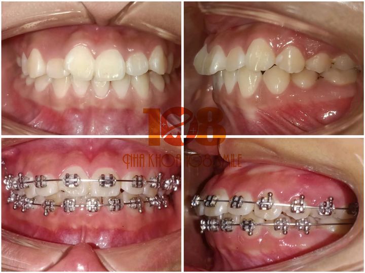 NHA KHOA QUẢNG YÊN - QUẢNG NINH  🔶️01 BÁC SĨ  có định hướng implant hoặc chỉnh nha ( không có kinh nghiệm được đào tạo) 🔶️03 KTV, ĐIỀU DƯỠNG