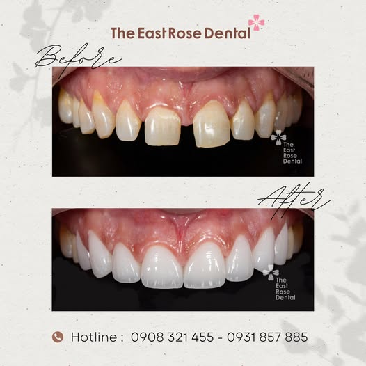 The East Rose Dental chiêu hiền đãi sĩ, đãi “cát “tìm người hiền tài !
